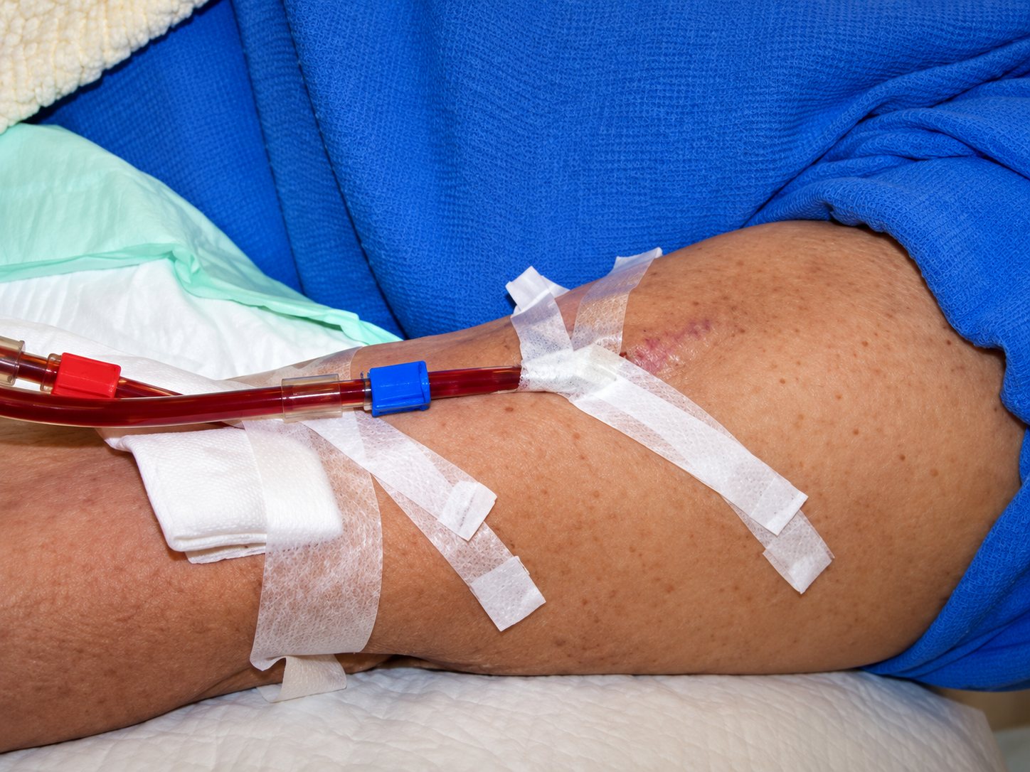 Bras d’un patient relié à une ligne de dialyse fixée par du ruban adhésif