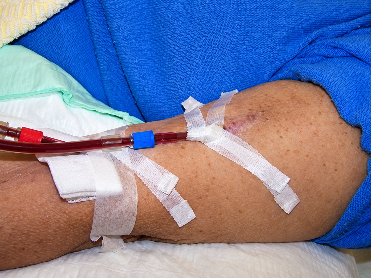 Bras d’un patient relié à une ligne de dialyse fixée par du ruban adhésif